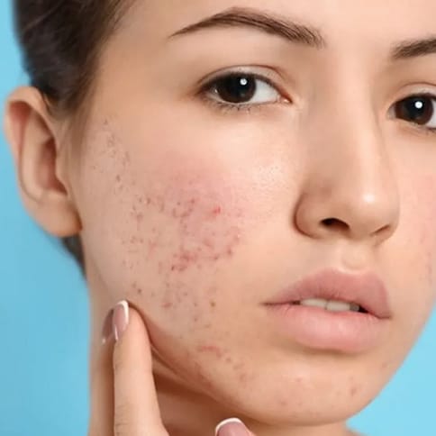 Acne scar treatment in Greater Noida