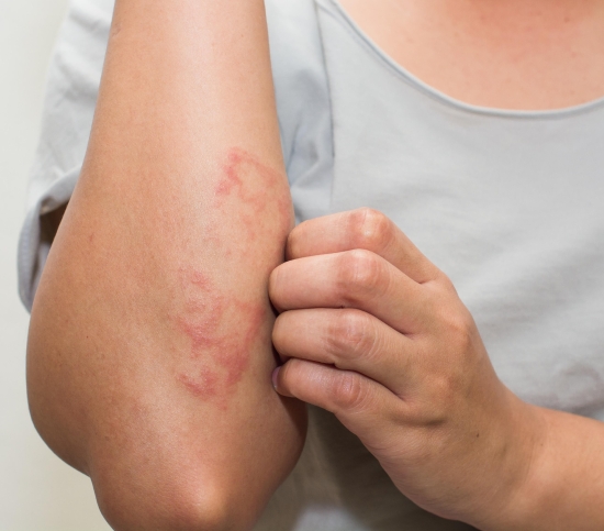 Eczema Treatment in Noida