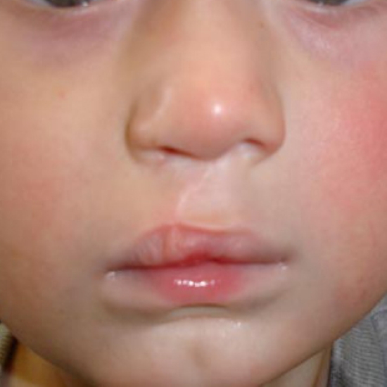 Cleft Lip and Palate Surgery in Noida 
