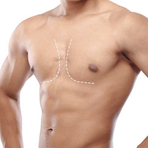 Gynaecomastia inNoida
