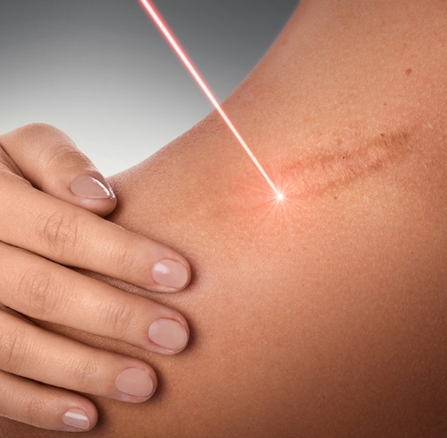 Keloids Treatment inNoida