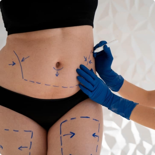 Liposuction Treatment in south Delhi