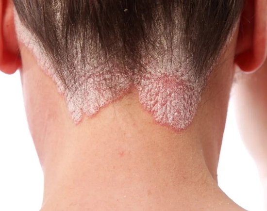 Psoriasis Treatment in Greater Noida 
