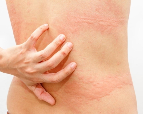 Urticaria Treatment in Greater Noida