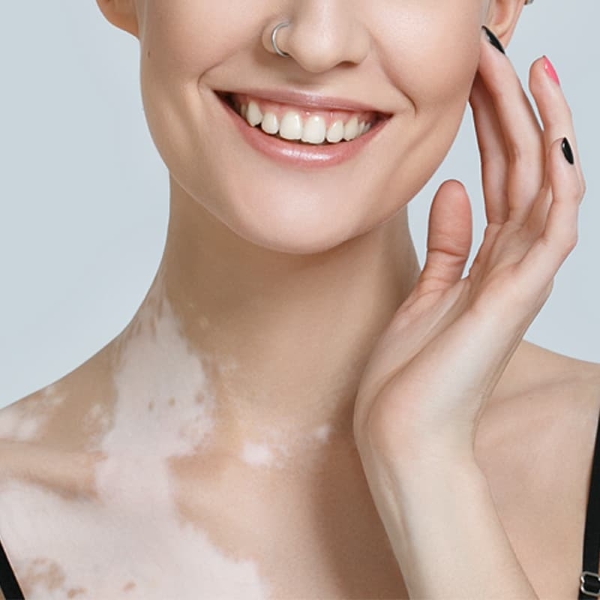 Vitiligo Treatment inNoida